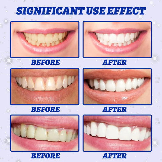 5D Gel Teeth Whitening Strips